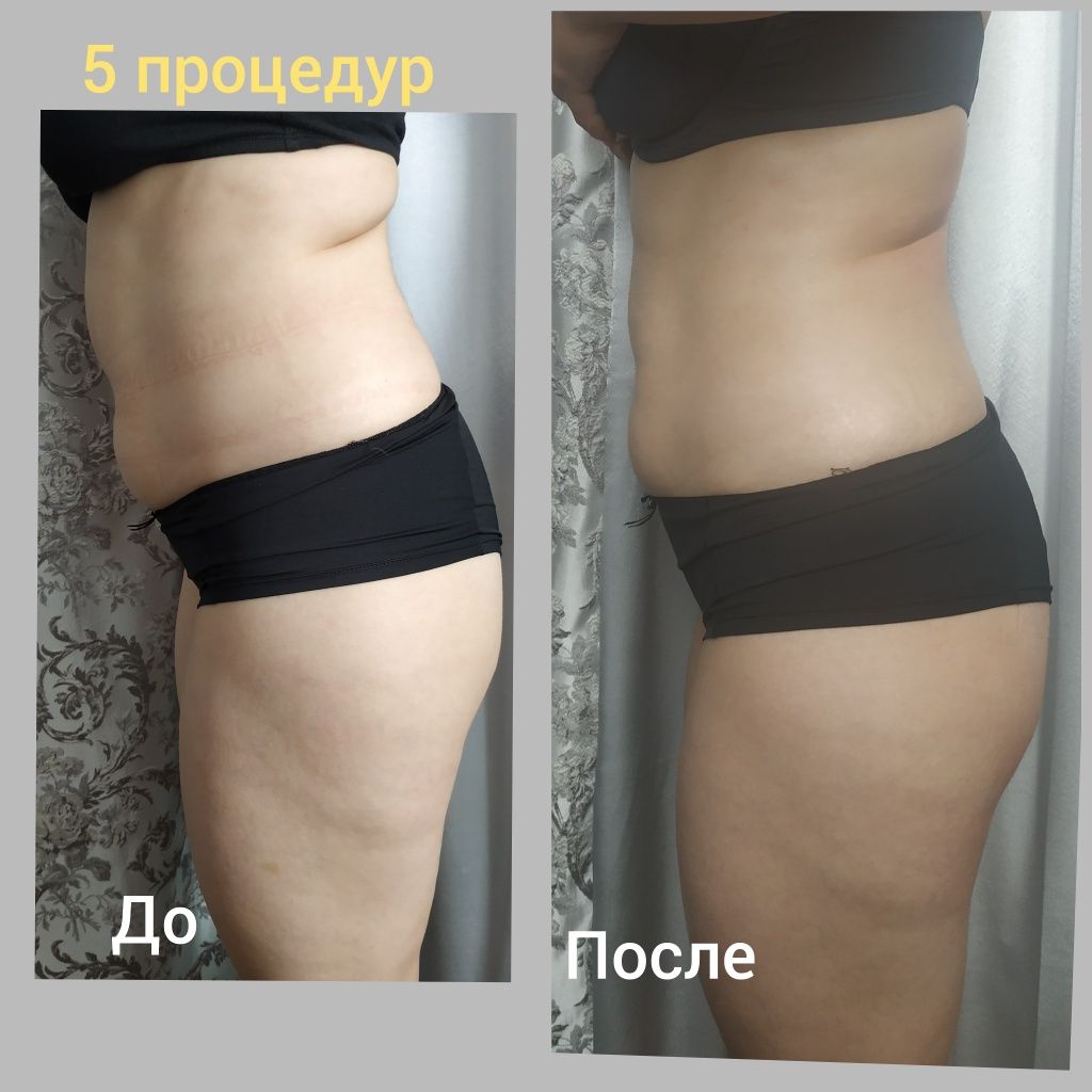 Фото Вакуумно- роликовый массаж  убирает все все " накопления " в проблемных областях, тем тем самым снижая объем тела и выравнивания поверхность кожи. Сочетание вакуума с механическим массажем, оказывает воздействие разрыхления и равномерное распределение массы жира. 