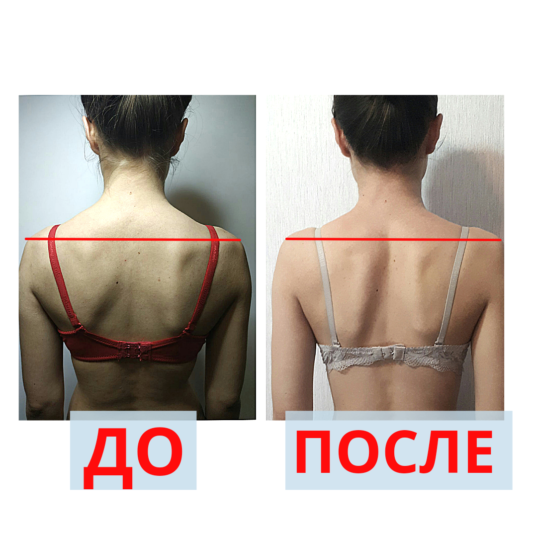 Фото До та пусля, відпрацювали шию, спину.