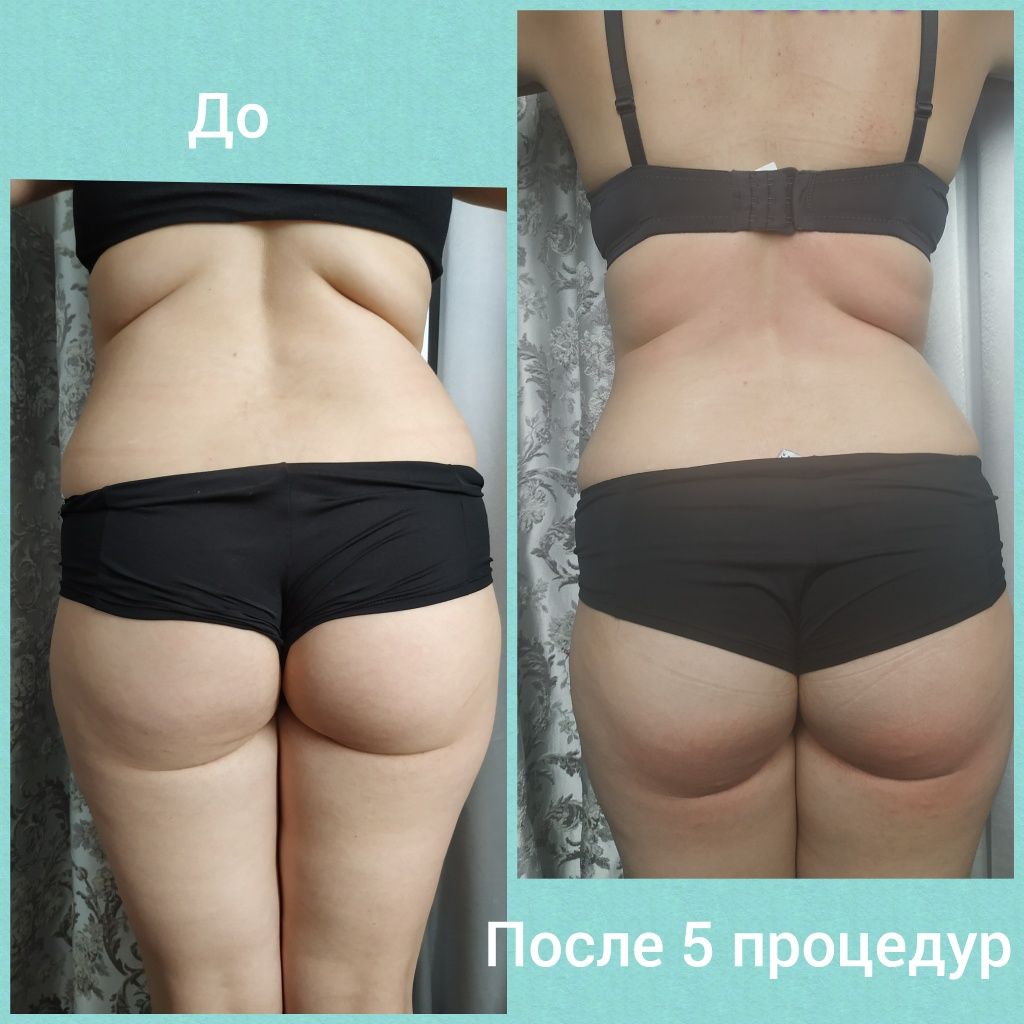 Фото Вакуумно-роликовый массаж - это метод коррекции фигуры с помощью оборудования, предназначеного для борьбы с целлюлитом и излишним жиром. В связи с активным обогащением кислородом клеток усиливаются процессы липолиза ( расщепление жиров ), в результате чего человек теряет вес