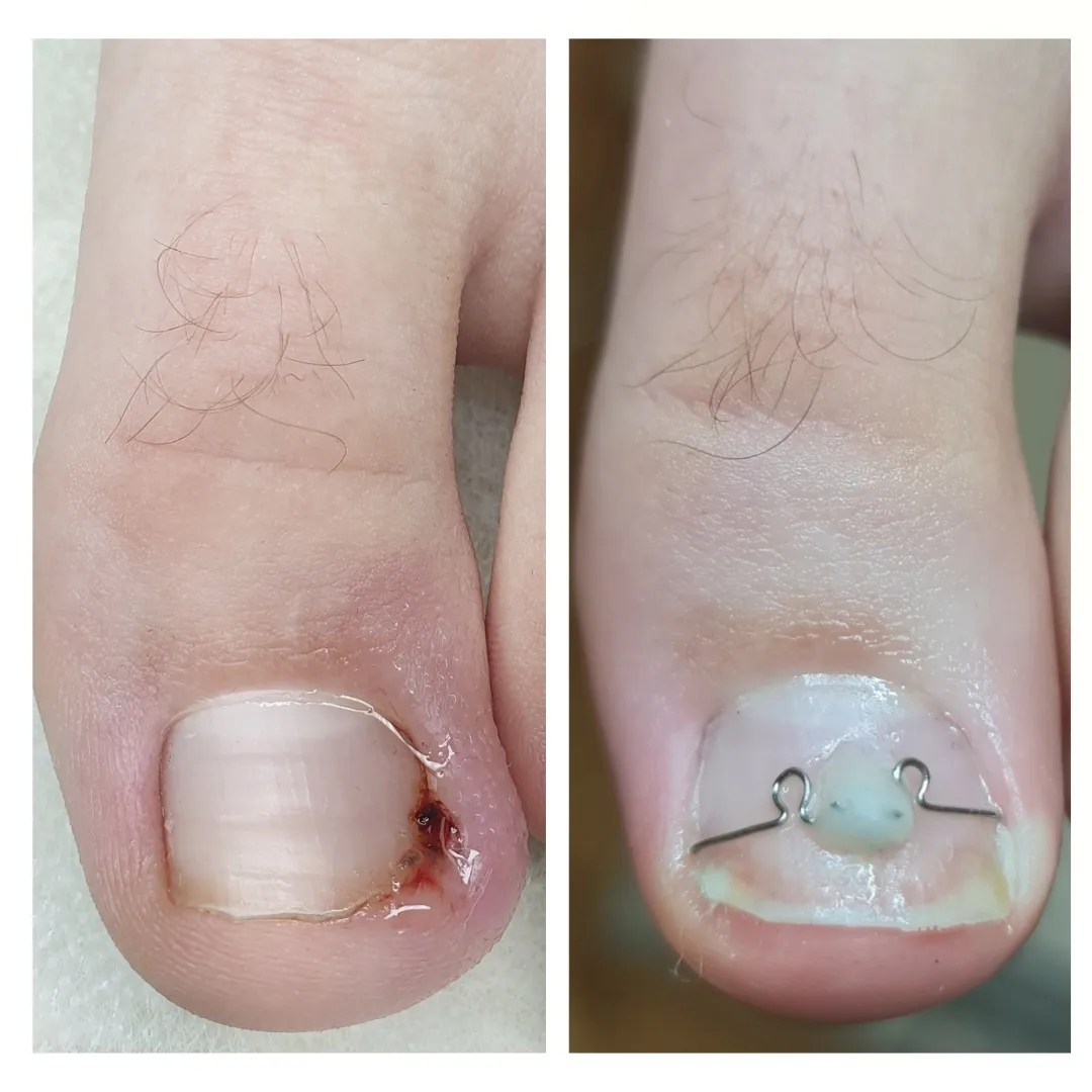 Фото Лечение вросшего ногтя в Одессе 