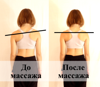Фото До массажа Юмейхо у пациентки наблюдается наклон туловища влево из-за искривления позвоночника. После проведения полного курса массажа Юмейхо сколиотическая осанка скорректирована, благодаря чему наклон туловища устранен.