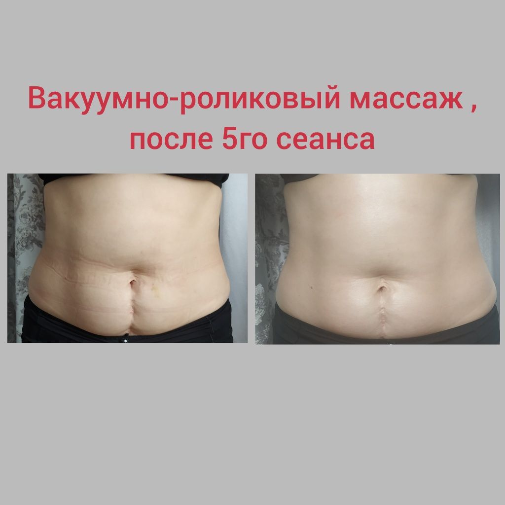 Фото Вакуумно-роликовый аппаратный массаж.
На жировую ткань вакуумно-роликовый массаж действует через общее воздействие на обмен веществ. Повышая обменные процессы в организме, усиливая выделение жира из жирового депо, массаж способствует " сгоранию " жиров.
