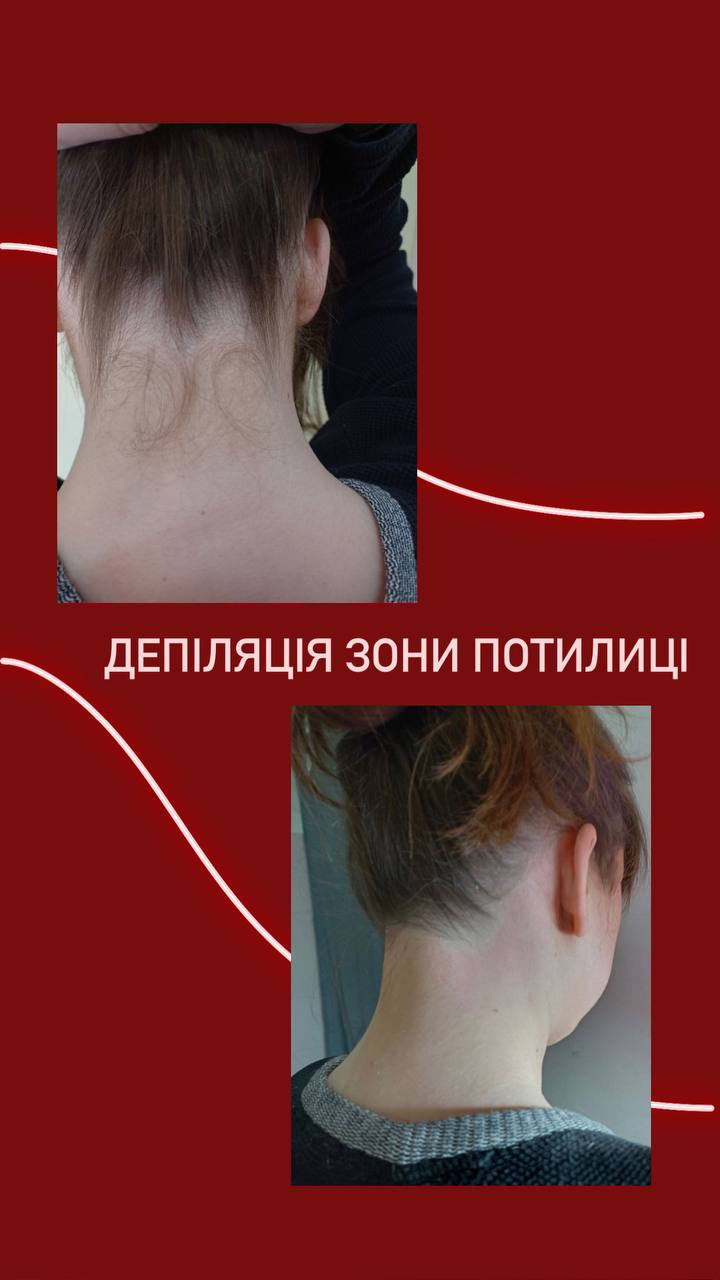 Фото Депіляція зони потилиці